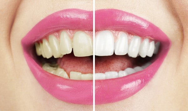 What Early Signs of Oral Cancer Should You Never Ignore Royal Leamington Spa?