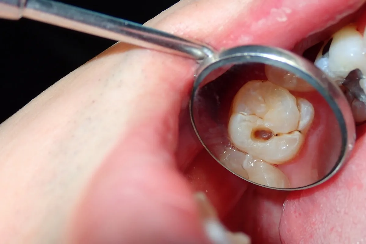 Why Do Teeth Crack? Common Causes to Know Royal Leamington Spa