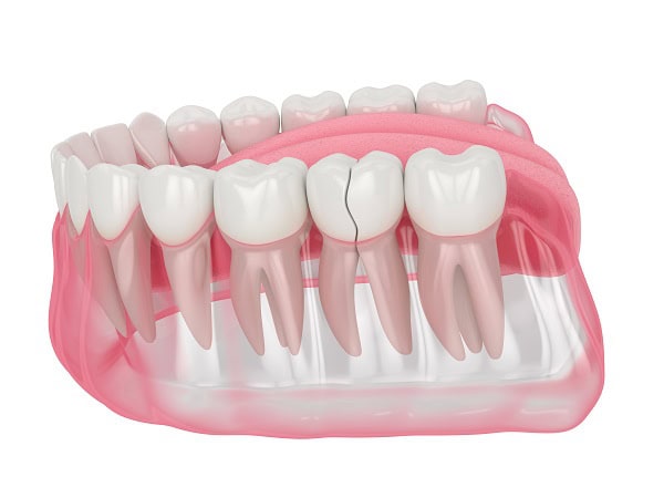How Can You Manage Pain and Discomfort After a Root Canal Royal Leamington Spa?