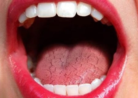 Common Causes of Dry Mouth (Xerostomia) Royal Leamington Spa