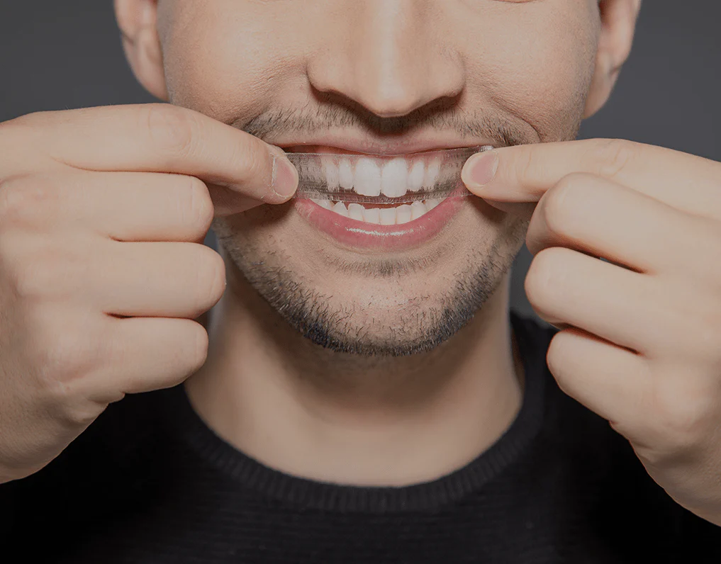 What to Consider Before Choosing a Teeth Whitening Option Royal Leamington Spa