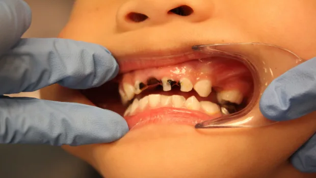 Which Foods and Drinks Cause the Most Damage to Young Smiles Royal Leamington Spa?