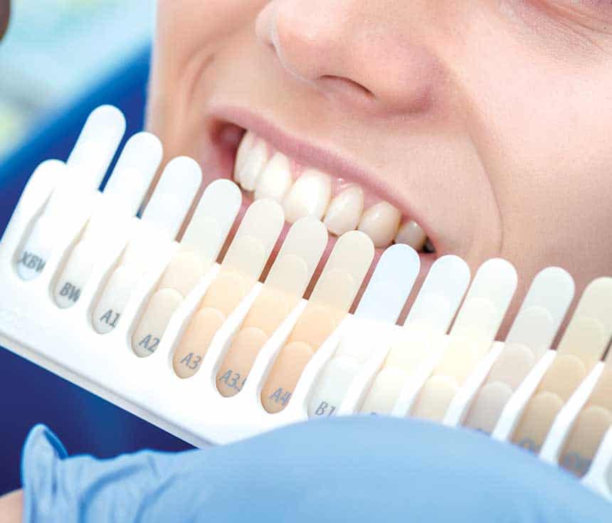 Professional vs At-Home Whitening: What You Need to Know Royal Leamington Spa